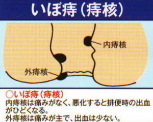 いぼ痔とは