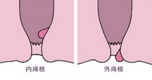 内外疣痔