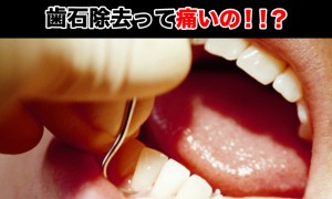 歯石とは？歯石除去って痛いのか？歯石予防なども調べた