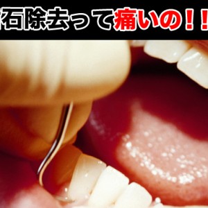 歯石とは？歯石除去って痛いのか？歯石予防なども調べた