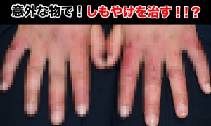 しもやけの治し方でおすすめなのは湿布！？