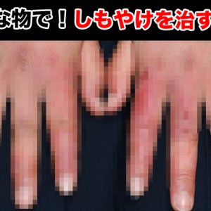 しもやけの治し方でおすすめなのは湿布!?